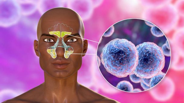 Sinüzitin sebebi olarak morakella catarrhalis bakterisi. 3 boyutlu illüstrasyon, Afrikalı bir adamda frontal sinüslerde iltihaplanma ve Moraxella bakterisinin yakın plan görüntülerini gösteriyor. - Fotoğraf, Görsel