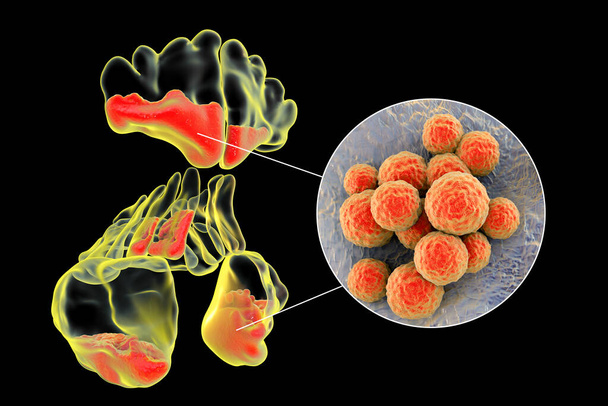 bacteria Staphylococcus aureus, SARM como causa de sinusitis. Ilustración 3D que muestra inflamación purulenta de senos frontales, maxilares y etmoides y vista de cerca de bacterias estafilocócicas - Foto, imagen