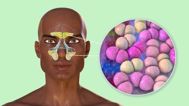 Streptococcus pneumoniae bacteria as a cause of sinusitis. 3D illustration showing purulent inflammation of frontal sinuses in an African man and close-up view of streptococci bacteria - Photo, Image