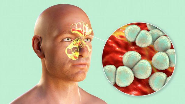 Bactéries Streptococcus pneumoniae comme cause de sinusite. Illustration 3D montrant une inflammation purulente des sinus frontaux, maxillaires et ethmoïdes et une vue rapprochée des bactéries pneumococciques - Photo, image
