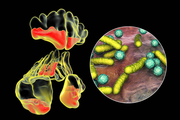 Синусит, воспаление параназальных полостей. 3D иллюстрация, показывающая гнойное воспаление лобных, верхнечелюстных и этимоидных пазух и крупным планом вид бактерий, вызывающих синусит - Фото, изображение