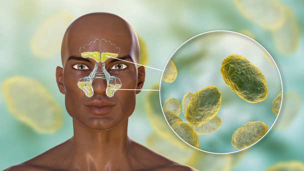 Sinüzitin nedeni olarak hemofili gribi bakterisi. 3 boyutlu illüstrasyon, Afrikalı bir adamda frontal sinüslerin iltihaplandığını ve Haemophilus bakterisine yakından baktığını gösteriyor. - Fotoğraf, Görsel