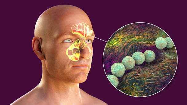 Streptococcus pyogenes βακτήρια ως αιτία της ιγμορίτιδας. 3D απεικόνιση που δείχνει πυώδη φλεγμονή των μετωπικών, άνω γνάθου, και ηθμοειδών κόλπων και κοντινή προβολή των βακτηρίων στρεπτόκοκκων - Φωτογραφία, εικόνα