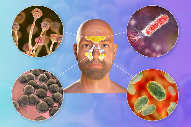 Rhinosinusitis і мікроорганізми, які викликають синусит, гриби Aspergillus, бактерії Pseudomonas aeruginosa, Streptococcus pneumoniae і Haemophilus influenzae, 3D-ілюстрація - Фото, зображення