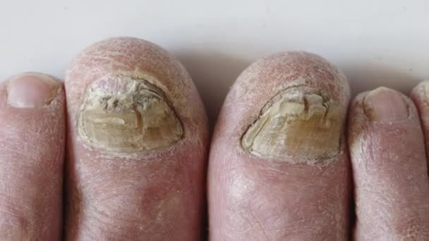 Sluiten van een voet met beschadigde nagels als gevolg van schimmel. Oudere mannenbenen. - Video
