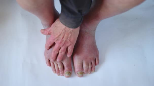Sluiten van een voet met beschadigde nagels als gevolg van schimmel. Oudere mannenbenen. - Video