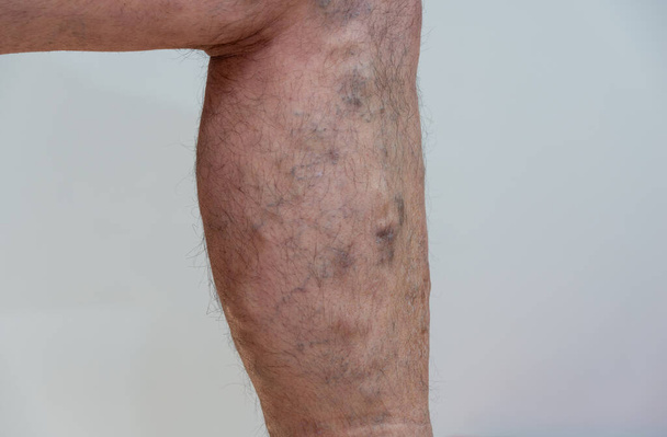 Varicose Vein on elderly male legs on white background . - Photo, Image