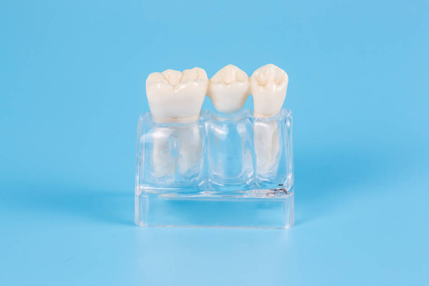 Пластикові зубні коронки, імітація зубного протезу зубного моста на один зуб на синьому фоні. Візуальна допомога стоматологам та пацієнтам
. - Фото, зображення
