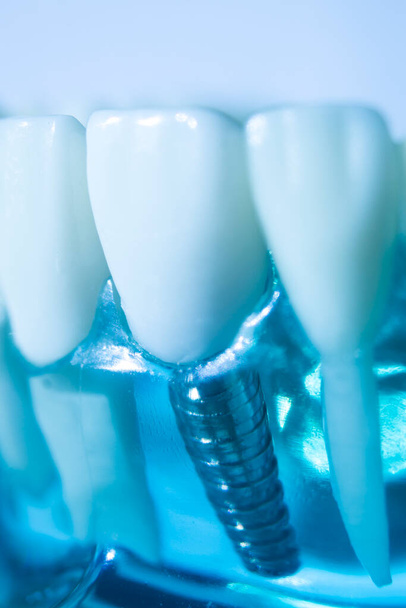 Modelo de enseñanza de odontología de implantes de metal dental que muestra dientes y encías. - Foto, Imagen