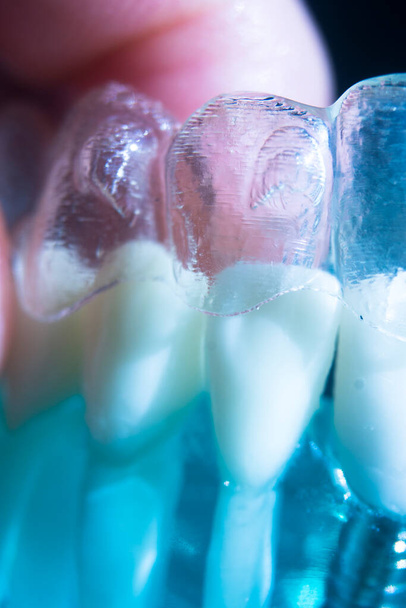 Σύγχρονα αόρατα στηρίγματα aligner ισιωτικά που χρησιμοποιούνται για τη διόρθωση της ευθυγράμμισης στα δόντια από οδοντίατρους. - Φωτογραφία, εικόνα