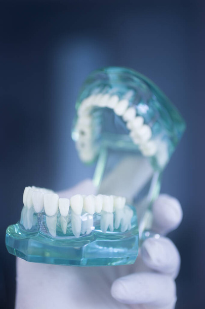 Dental dente implante titânio prótese dentistas modelo. - Foto, Imagem