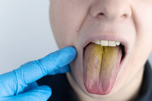 O homem tem uma língua amarela. Revestimento amarelo doloroso na membrana mucosa da língua. Doenças do trato gastrointestinal, fígado e vesícula biliar. Consequências da toma de antibióticos. - Foto, Imagem