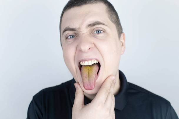 El hombre tiene una lengua amarilla. Recubrimiento amarillo doloroso en la membrana mucosa de la lengua. Enfermedades del tracto gastrointestinal, hígado y vesícula biliar. Las consecuencias de tomar antibióticos. - Foto, imagen