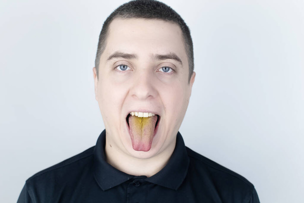 男は黄色い舌を持っている。舌の粘膜に痛みを伴う黄色のコーティング.消化管の病気,肝臓と胆嚢.抗生物質を服用した結果. - 写真・画像