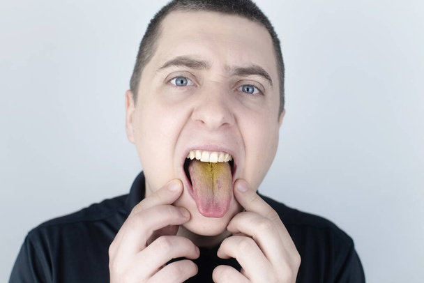 Cet homme a une langue jaune. Revêtement jaune douloureux sur la muqueuse de la langue. Maladies du tube digestif, du foie et de la vésicule biliaire. Les conséquences de la prise d'antibiotiques. - Photo, image