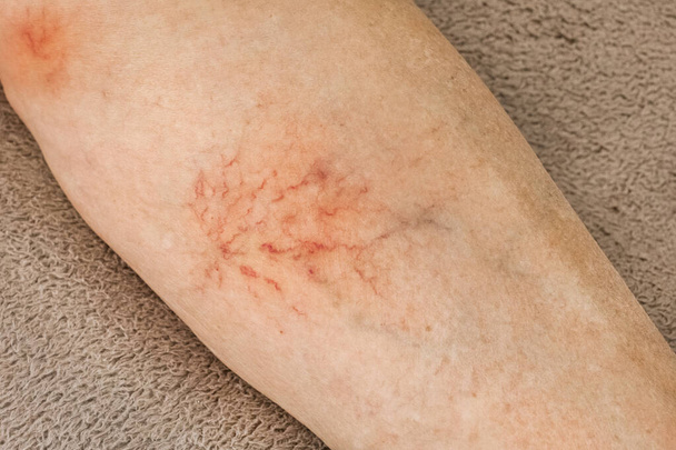Varicose veins, sore female leg, venous disease. - Photo, Image