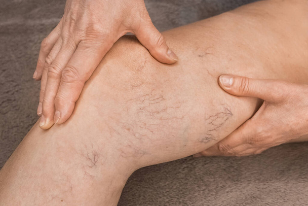 Руки літньої жінки показують на варикозних венах, хворих жіночих ногах
. - Фото, зображення