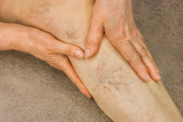 Руки літньої жінки показують на варикозних венах, хворих жіночих ногах
. - Фото, зображення