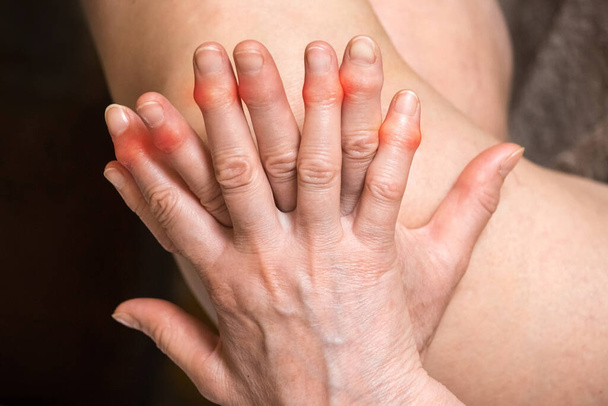 Las manos de una anciana con los dedos doloridos. Concepto de tratamiento de dedos. - Foto, imagen