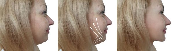 femme visage double menton avant et après le traitement - Photo, image