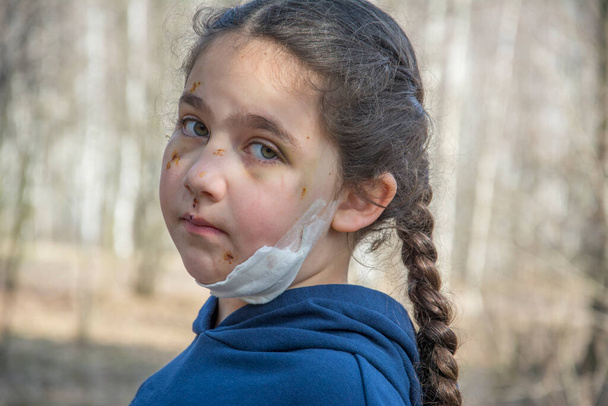 In the spring afternoon, in the forest, the girl's face is all scratched and bruised after a dog bite. - Zdjęcie, obraz