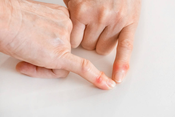 Дві руки літньої жінки вказують на хворобу пальців і зміну суглобів крупним планом
. - Фото, зображення