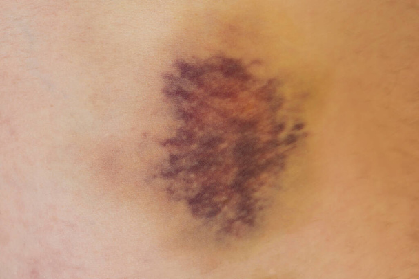 Enorme paarse blauwe plekken met bloeding op de menselijke huid - Foto, afbeelding