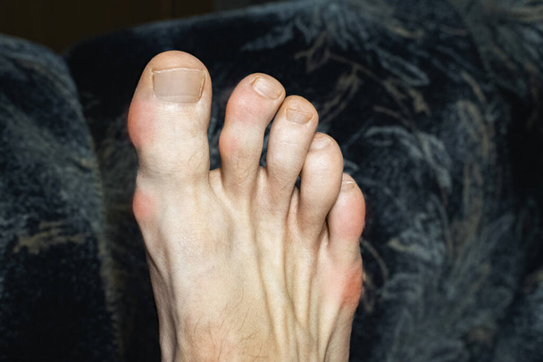 gezwollen en misvormde vingers met osteofyten. ontsteking van de tenen als gevolg van jicht of artritis. gezwollen gewrichten van tenen - Foto, afbeelding