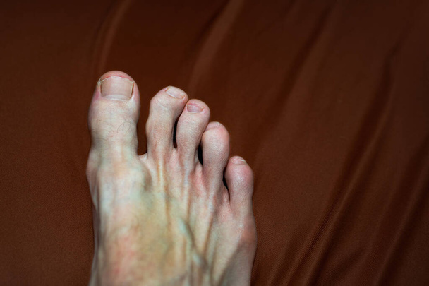 inflamed and deformed joints on the toes due to arthritis or gout. osteophytes on the toes of a foot. Osteophytes or exostoses (bony projections) that form along with joint margins osteophytes on the toes. Osteophytes on the fingers or toes ar - Photo, Image