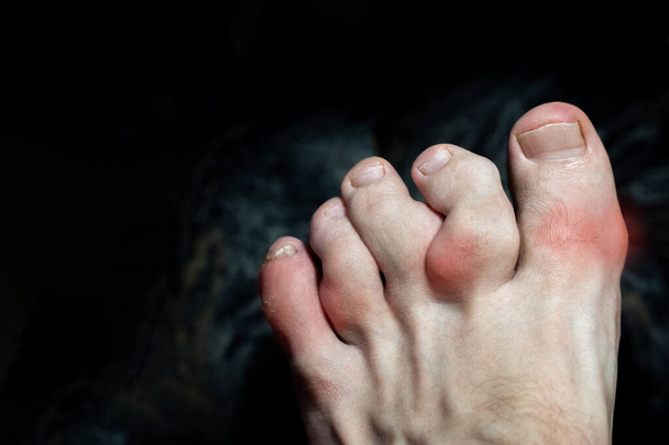 osteofyten op de tenen van een voet gewond door jicht of de ziekte van Ollier. Ontsteking en misvorming van de tenen. Maffucci syndroom van de tenen met tumoren van bot en weke delen. Osteofyten op de vingerbotten - Foto, afbeelding