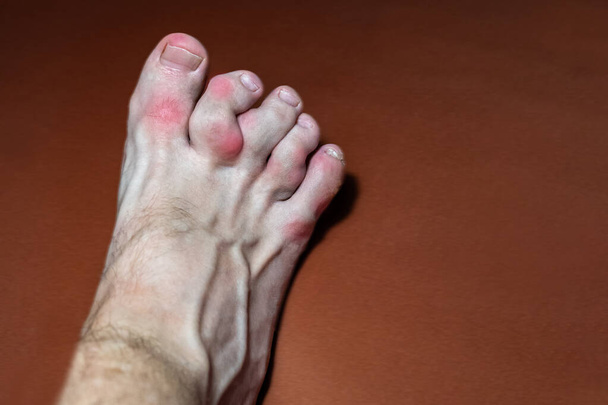 Köszvényes lábujjak közelsége. a köszvény által érintett lábujjak - olyan betegség, amelyben a húgysav hibás metabolizmusa ízületi gyulladást okoz. Köszvény is ismert, mint "a betegség a királyok" - Fotó, kép