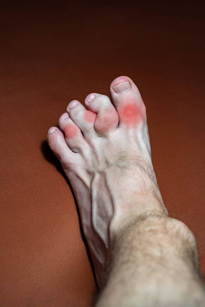 Ayak parmakları gutlu bir bacak. Gut gazından etkilenen ayak parmakları. Ürik asitin kusurlu metabolizmasının özellikle küçük kemiklerde kireçlenmeye yol açtığı bir hastalık. Gut hastalığı aynı zamanda "kralların hastalığı" olarak da bilinir.". - Fotoğraf, Görsel