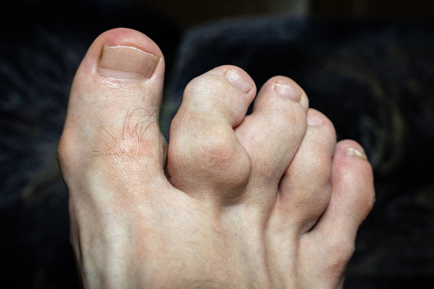 zdeformowane palce u stóp po wielokrotnych złamaniach. obrzęk stawów palców u nóg u nóg. Bolesne zapalenie dny moczanowej na stawach stóp, selektywne skupienie. dnawe palce u nóg. palce dotknięte dny moczanowej, selektywne skupienie - Zdjęcie, obraz