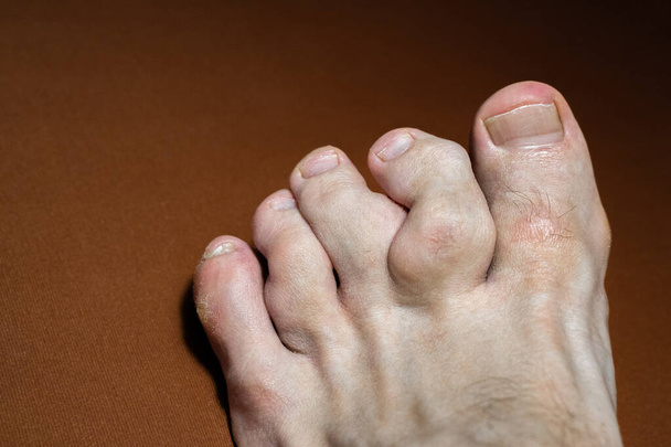 Síndrome de Maffucci de los dedos de los pies con tumores de hueso y tejidos blandos. La deformidad causa dolor en el pie y preocupación cosmética. Inflamación dolorosa de la gota en las articulaciones del dedo - Foto, imagen