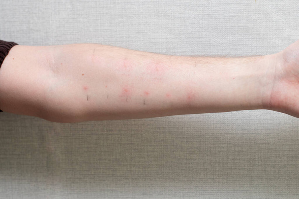 Чоловіча рука з позитивними аналізами алергії. Алергічні тести на руці
 - Фото, зображення