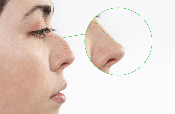 鼻形成術。鼻形成前と後の結果を示す女性の顔をクローズアップ.サイドビュー。白地だ。審美的な手術の概念. - 写真・画像
