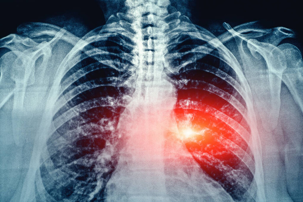 Acı ve hastalığın sembolü olarak kırmızı bölgede bulunan insan göğsü ve akciğerlerinin tahıl görüntüsü olan röntgen filmi. - Fotoğraf, Görsel