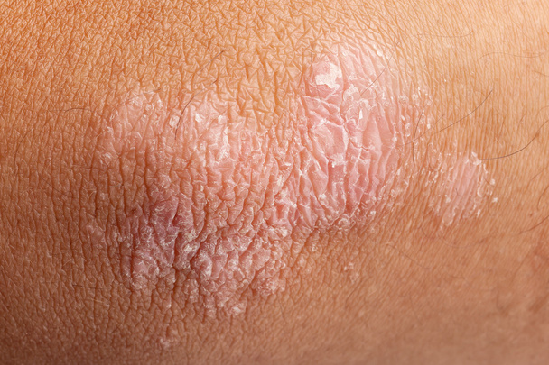 psoriasis op elleboog huid - Foto, afbeelding