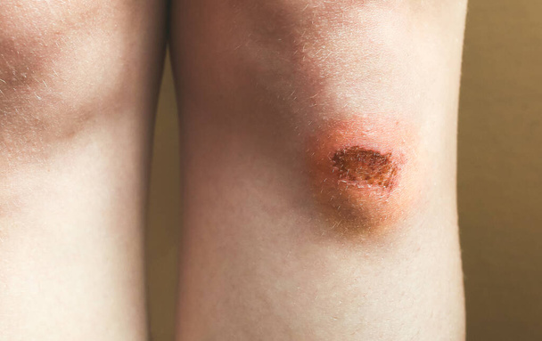 Abrasion on the woman's knee. Injured leg with a red wound. Medical treatment for first aid. - Photo, Image