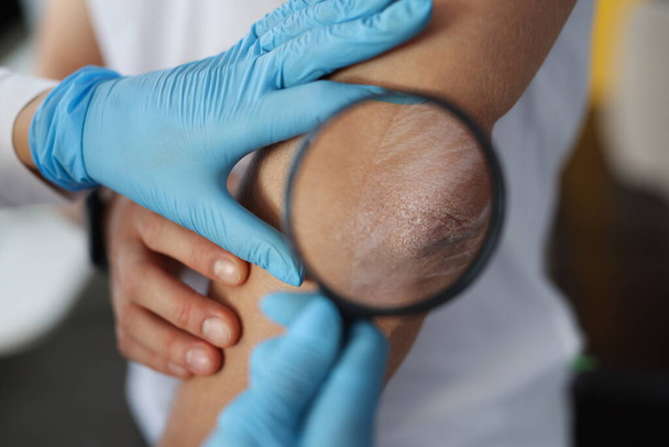 Γιατρός εξετάζει ασθενή φολιδωτό αγκώνα μέσα από μεγεθυντικό φακό - Φωτογραφία, εικόνα