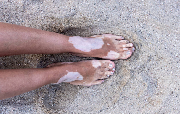 Lábak és lábak a nő vitiligo pigment spot betegség a tengerparton homok, másolás tér - Fotó, kép