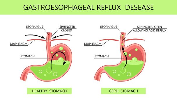 Gastrooesophagealis reflux betegség. Savas reflux, gyomorégés és gerd infografika orvosi vektor illusztrációval. Egészséges és beteg a gyomra. Gyógyászat anatómia egészséges, szerv és betegség GERD infografika - Vektor, kép