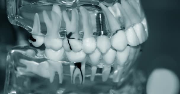 Modelo transparente de dientes humanos con implantes de primer plano - Imágenes, Vídeo