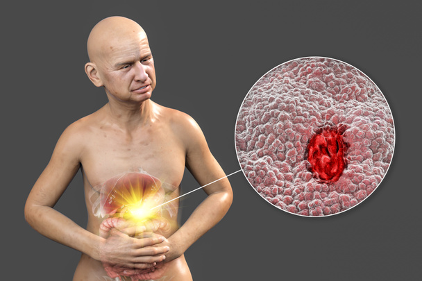 Ból brzucha, konceptualna ilustracja 3D. Pacjent cierpiący na wrzód żołądka z podkreślonymi narządami wewnętrznymi układu pokarmowego i bliskim widokiem na wrzód trawienny - Zdjęcie, obraz