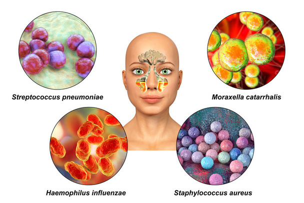 Anatomy of rhinosinusitis and bacteria that cause sinusitis Streptococcus pneumoniae, Moraxella catarrhalis, Haemophilus influenzae, and Staphylococcus aureus, labelled 3D illustration - Photo, Image