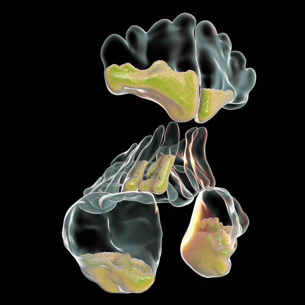 Sinusitis, inflammation of paranasal cavities. 3D illustration showing purulent inflammation of frontal, maxillary, and ethmoid sinuses, close-up view - Photo, Image