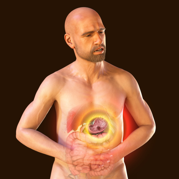 Ból brzucha, wrzód żołądka, konceptualna ilustracja 3D. Pacjent cierpiący na ból brzucha z podkreślonymi narządami wewnętrznymi i wrzodami żołądka - Zdjęcie, obraz