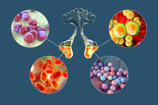 Anatomie von Rhinosinusitis und Bakterien, die Sinusitis verursachen Streptococcus pneumoniae, Moraxella catarrhalis, Haemophilus influenzae und Staphylococcus aureus, 3D-Illustration - Foto, Bild