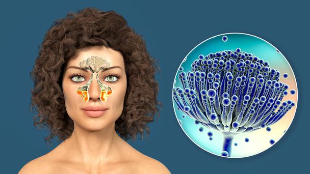 Aspergillus-Pilze als Ursache für Sinusitis. 3D-Illustration zur Entzündung der Kieferhöhlen bei einer weiblichen Person und Nahaufnahme des Aspergillus-Pilzes. Chronische Rhinosinusitis - Foto, Bild