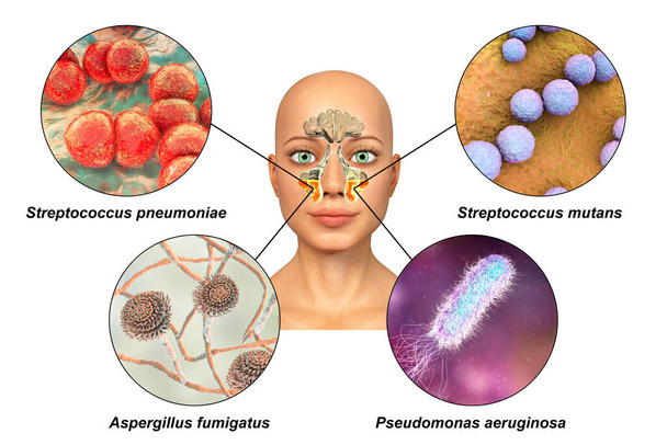 Anatomia della rinosinusite e dei microrganismi che causano sinusite Streptococcus pneumoniae, Streptococcus mutans, Aspergillus fumigatus e Pseudomonas aeruginosa, illustrazione 3D etichettata - Foto, immagini